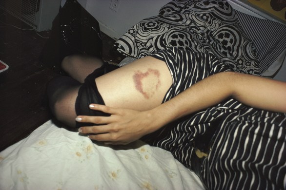 Nan Goldin Heart-shaped bruise, New York City 1980